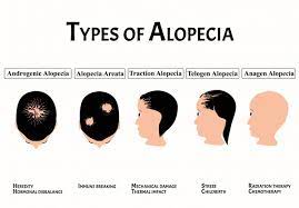What is Alopecia Areata?